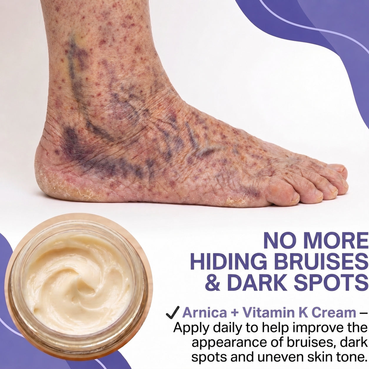 🔥Last Day-Buy 1 Get 1 Free🔥Skin-Strengthening Bruise Cream