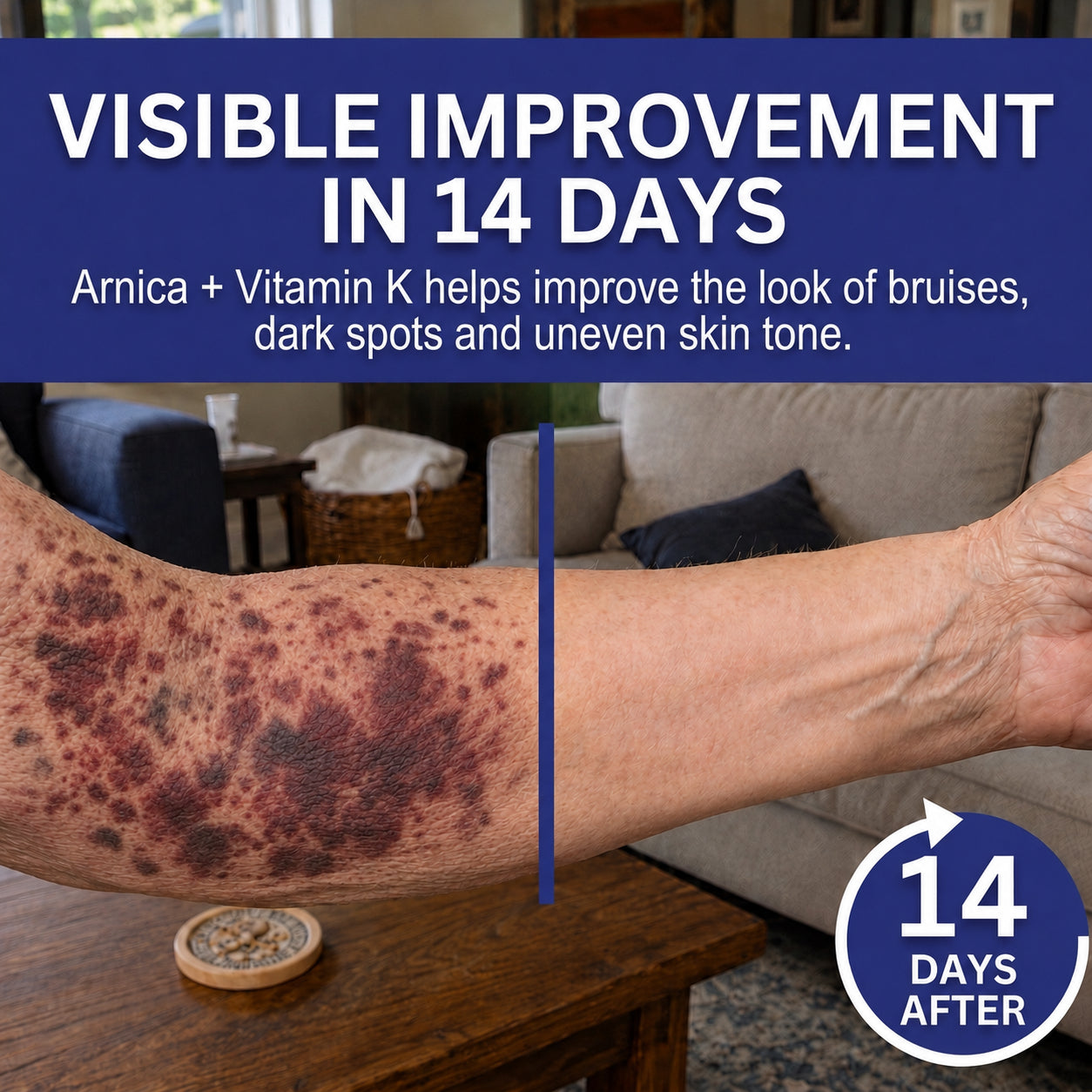 🔥Last Day-Buy 1 Get 1 Free🔥Skin-Strengthening Bruise Cream